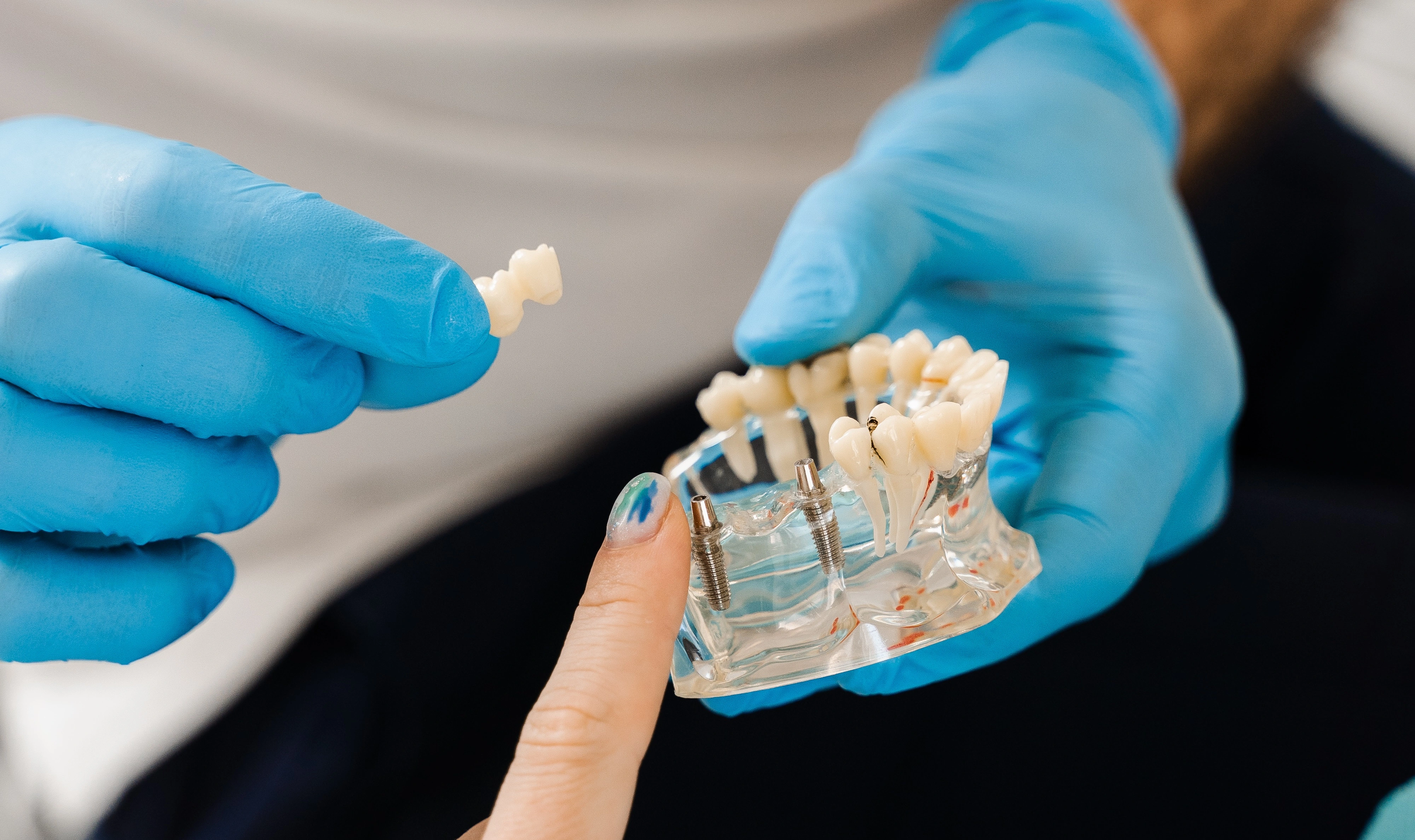 Der Arzt zeigt das Modell eines Kiefers, in dem zwei Implantate ingesetzt sind.