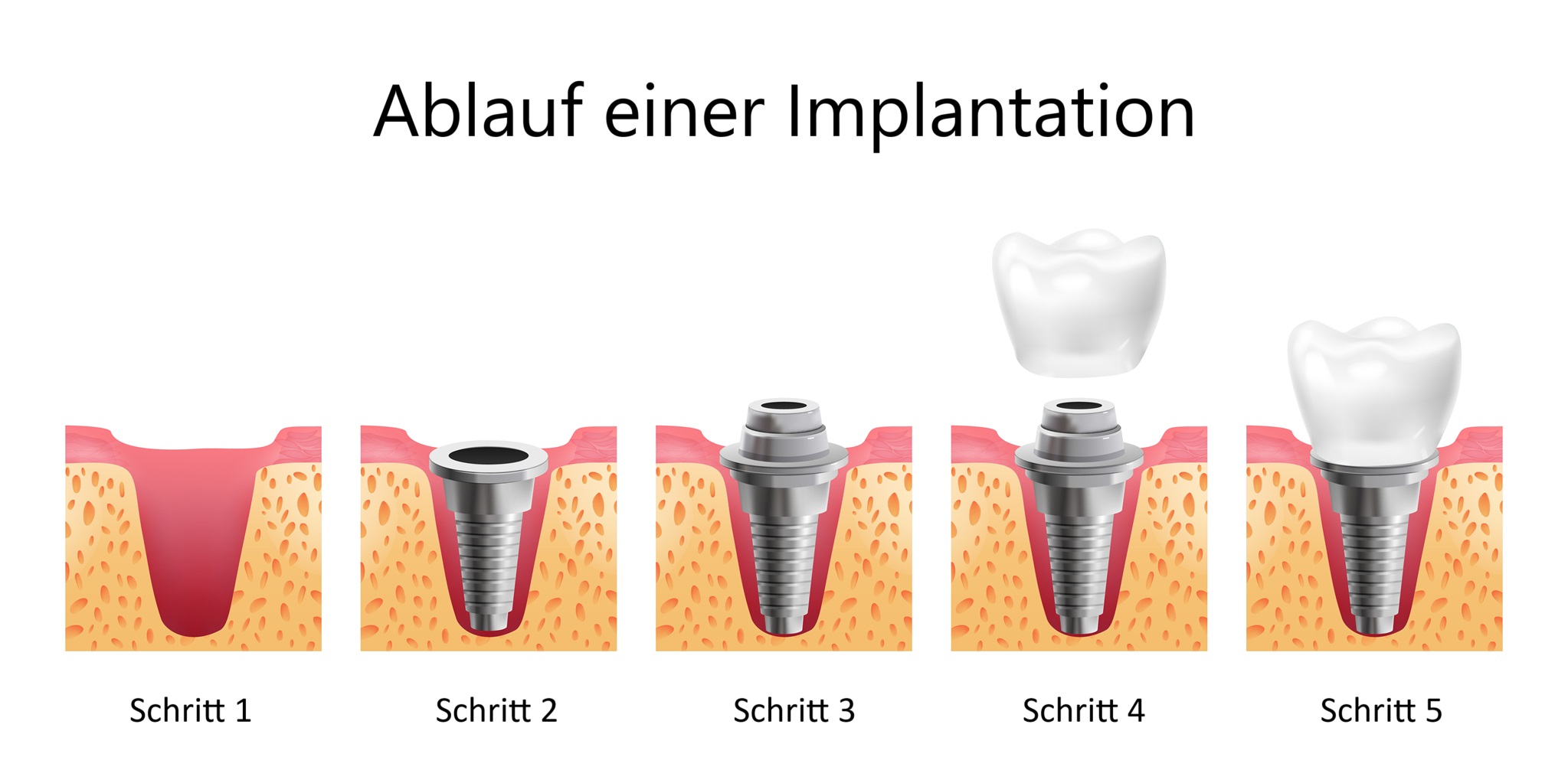 Schaubild: Ablauf einer Implantation