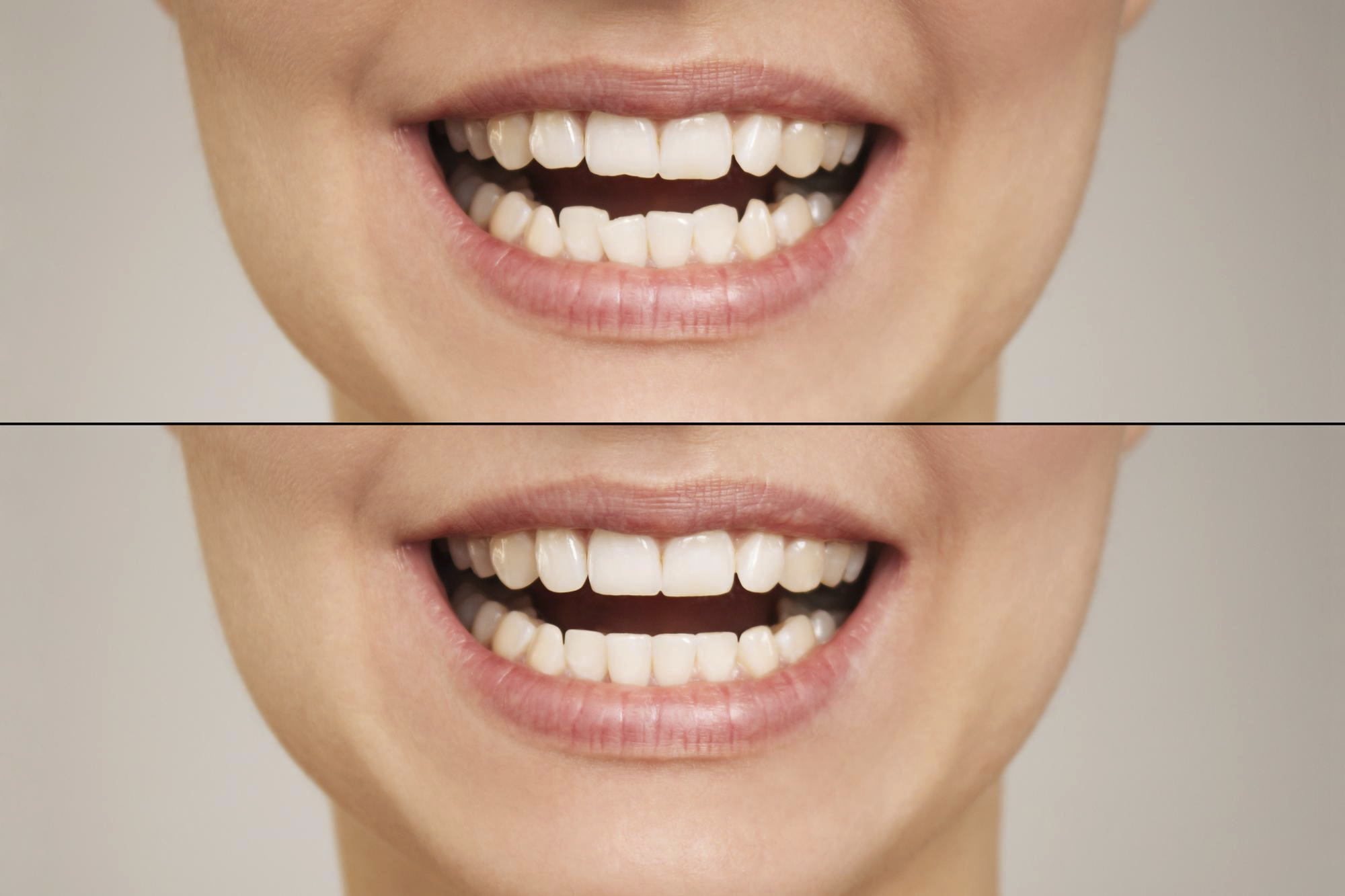 Schaubild: Wie Veneers auf die Zähne gesetzt werden