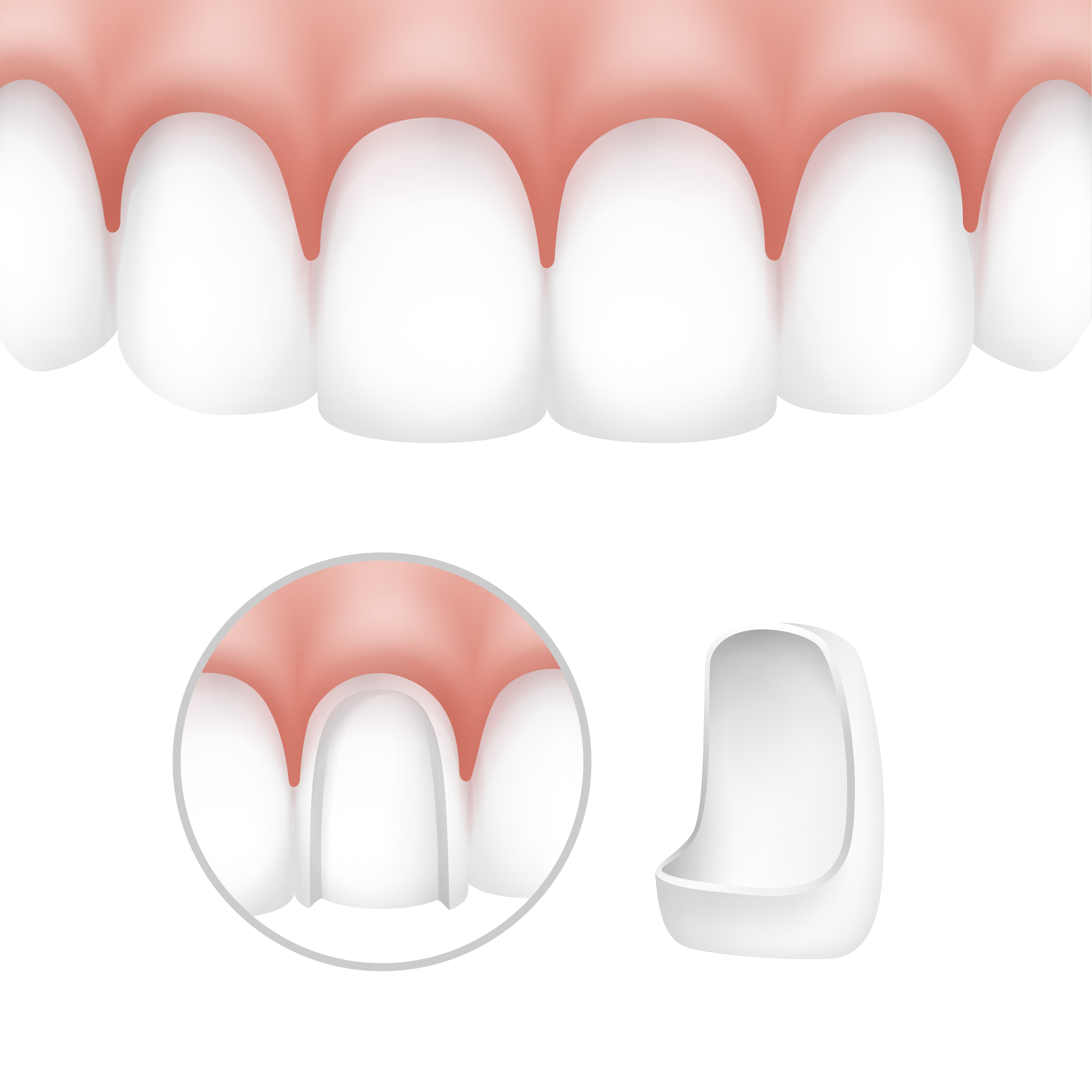 Schaubild: Wie Veneers auf die Zähne gesetzt werden