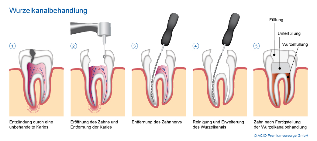 Schaubild: Wurzelkanalbehandlung Endodontie