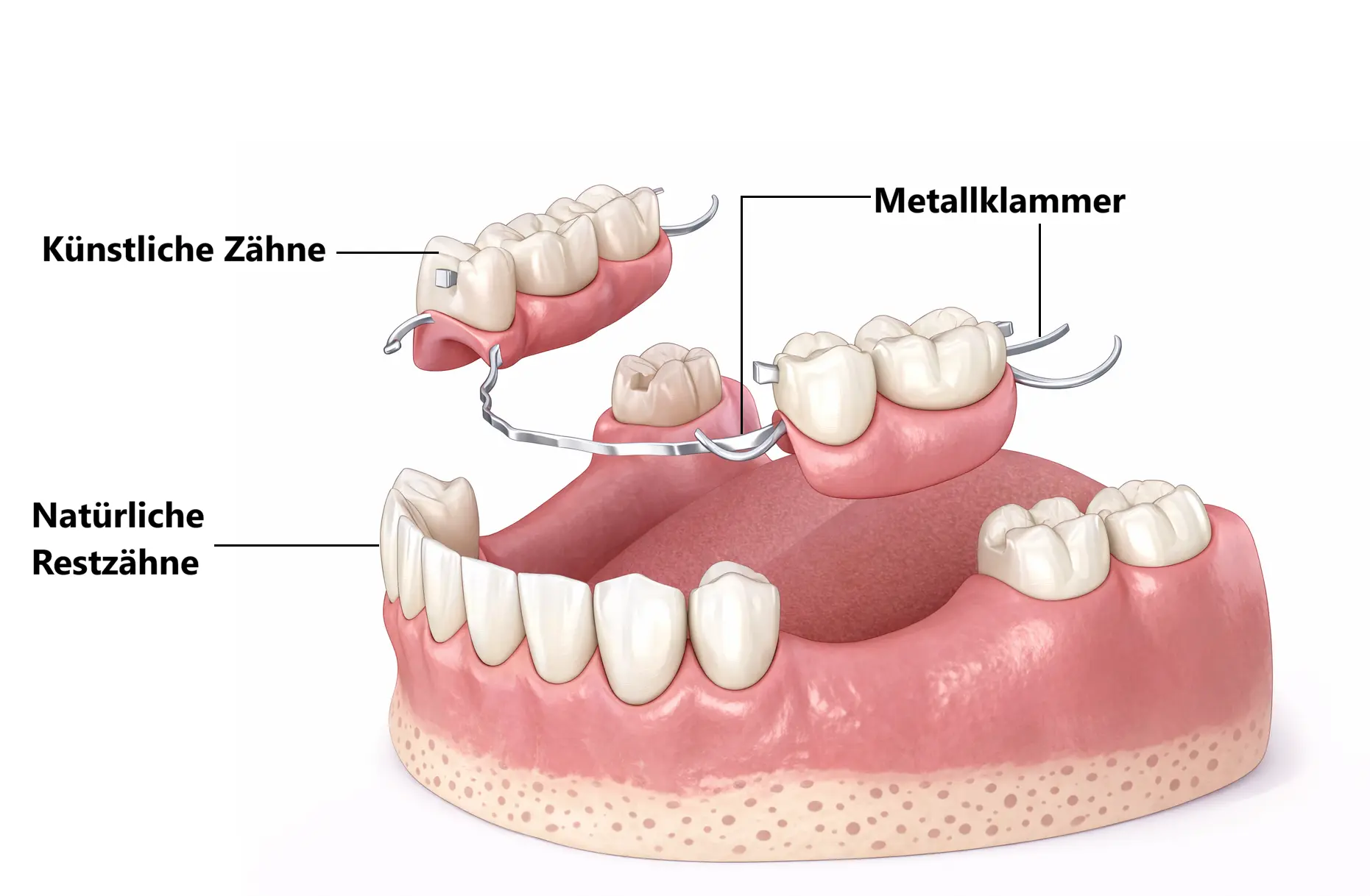 Schaubild: Aufbau und Funktion einer Teilprothese