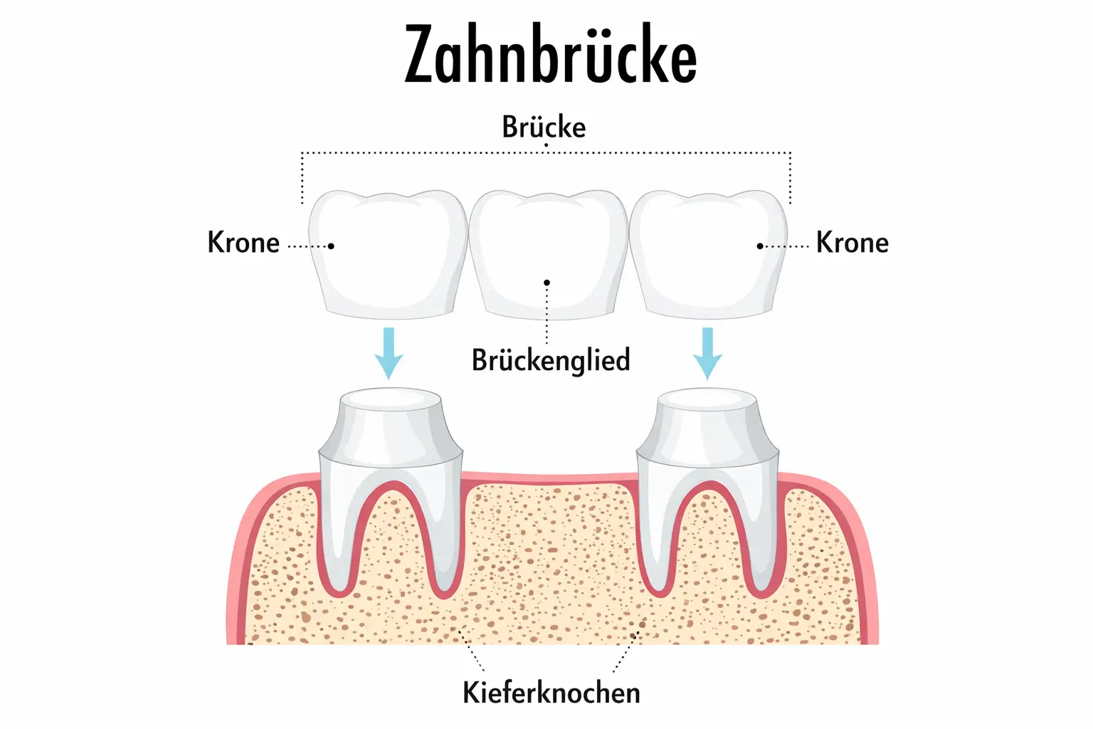 Schaubild: Aufbau und Funktion einer Zahnbrücke